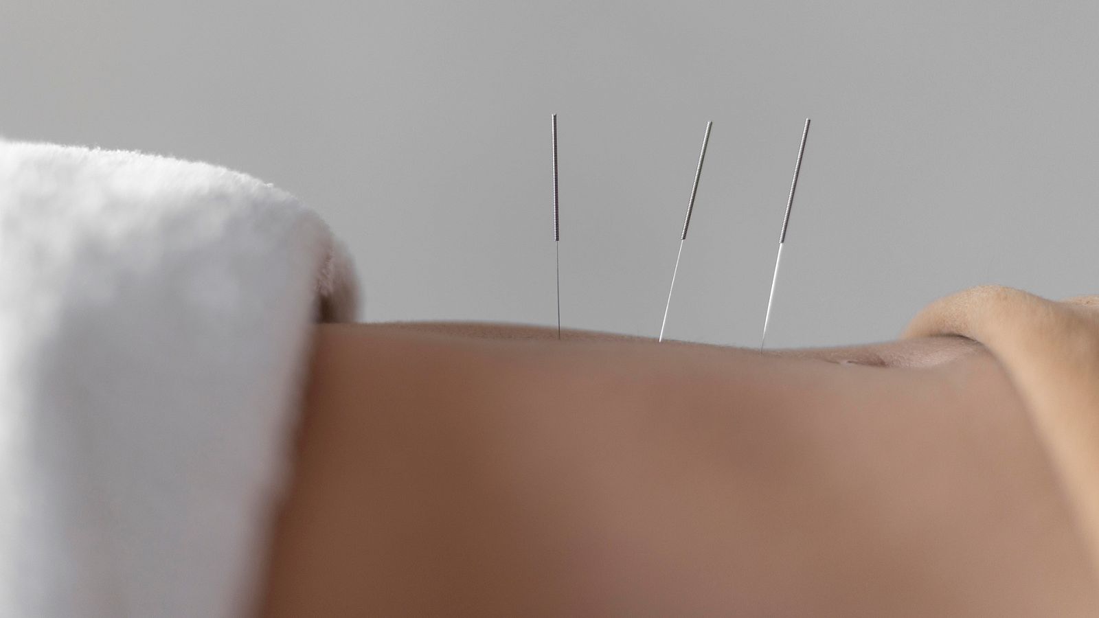 Иглорефлексотерапия: есть ли реальная польза или действует эффект плацебо?